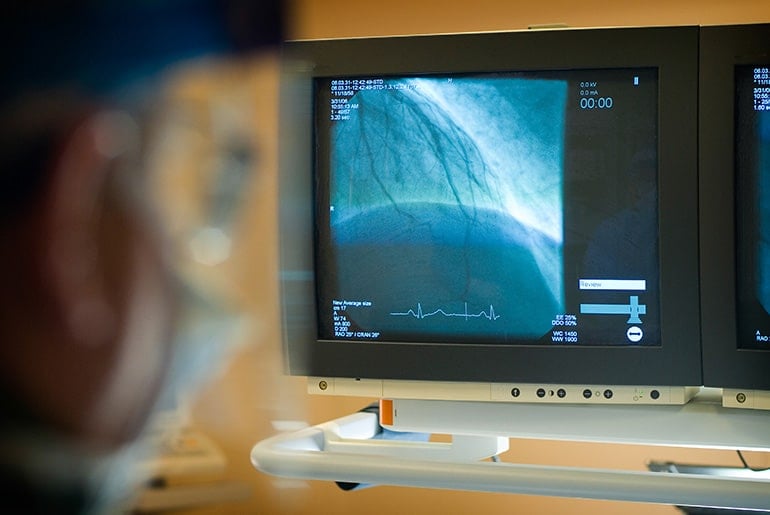 Close-up view of medical imaging monitors displaying cardiovascular images, with a blurred medical professional in the background